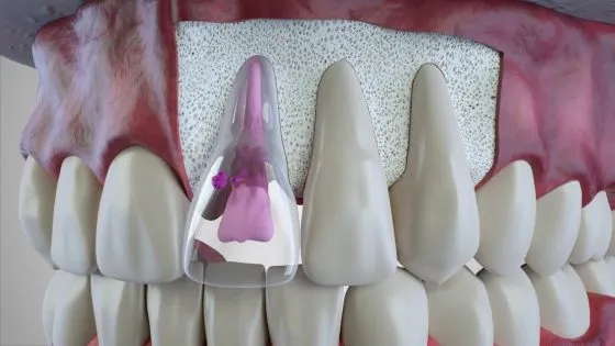 Types of Resorption thumbnail